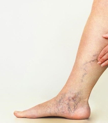 Varislerden Kurtulma Yöntemleri