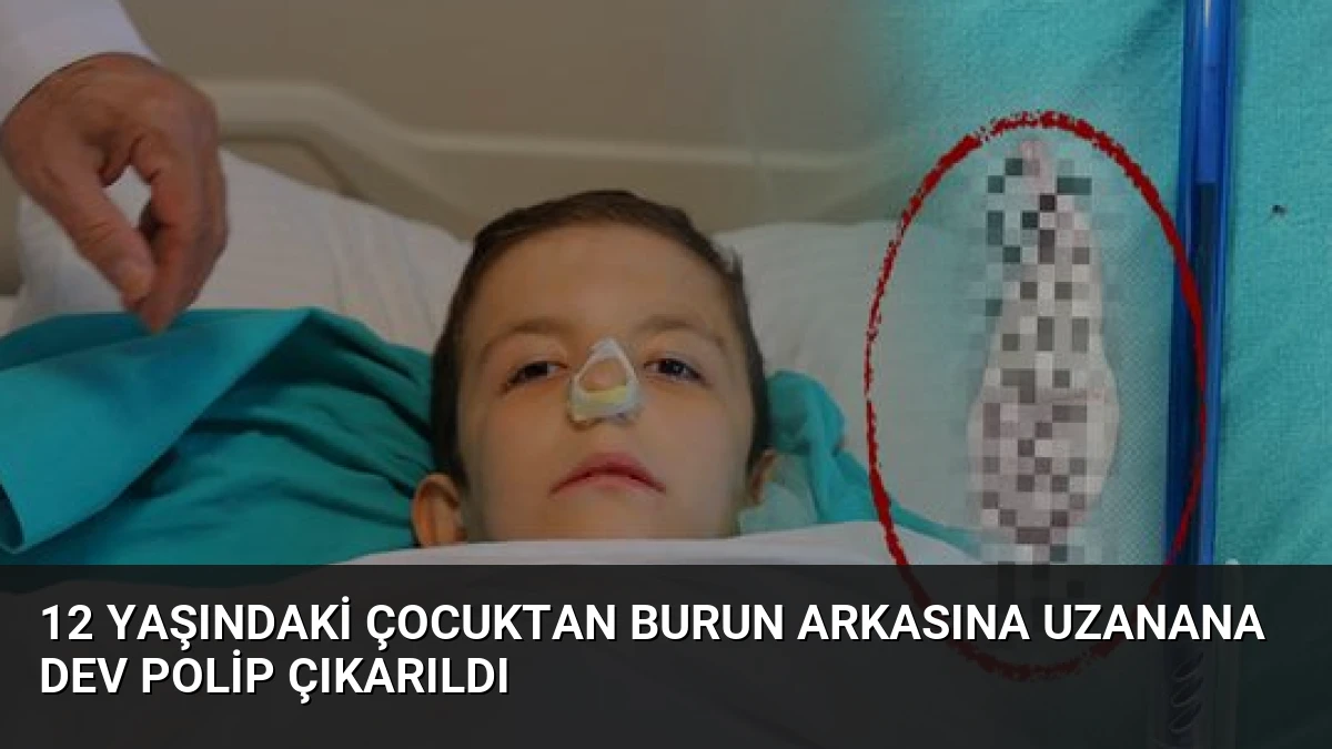 12 Yaşındaki Çocuktan Burun Arkasına Uzanana Dev Polip Çıkarıldı