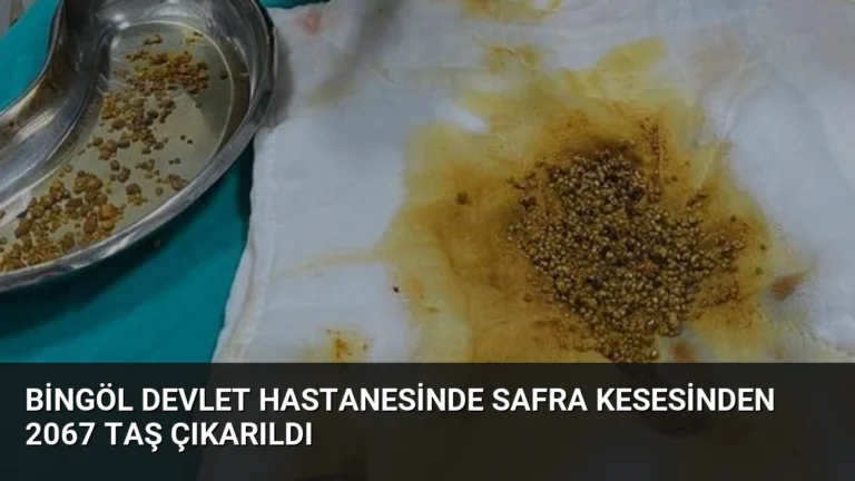 Bingöl Devlet Hastanesinde Safra Kesesinden 2067 Taş Çıkarıldı