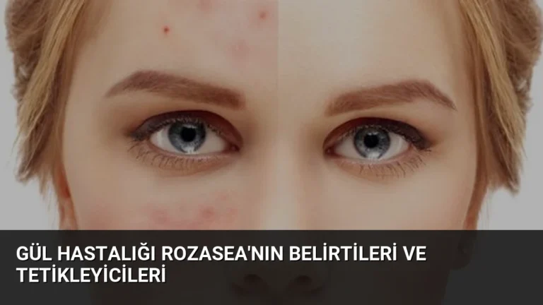 Gül Hastalığı Rozasea’nın Belirtileri ve Tetikleyicileri