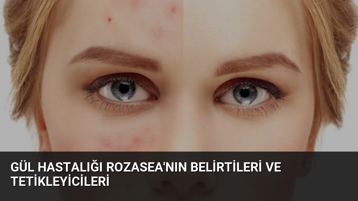 Gül Hastalığı Rozasea’nın Belirtileri ve Tetikleyicileri